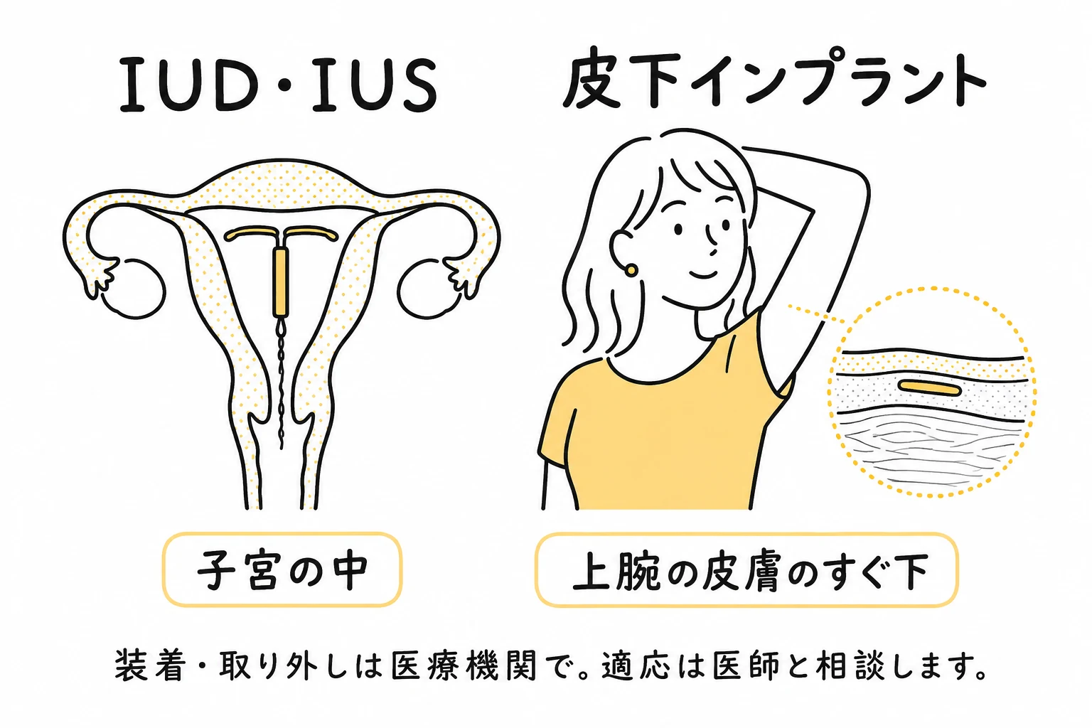 子宮内に装着するIUD・IUSと上腕の皮下に装着するインプラントの位置の違い
