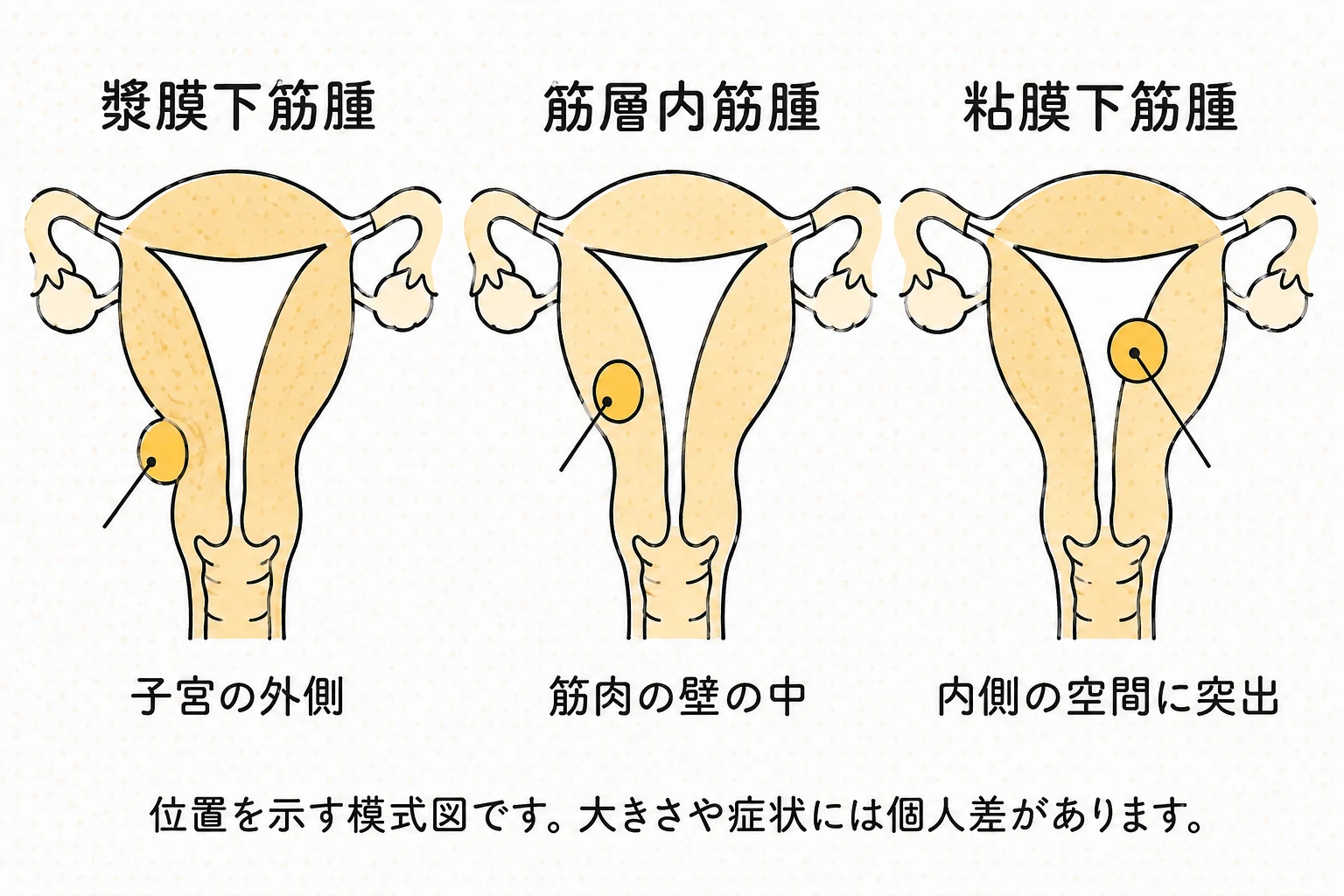子宮の外側にできる漿膜下筋腫、筋肉の壁の中の筋層内筋腫、内腔に突出する粘膜下筋腫の位置